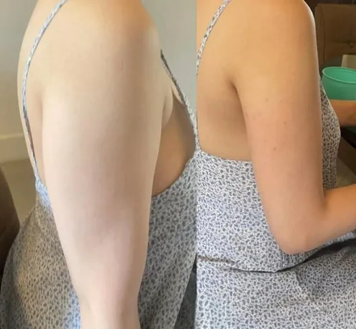 Beautox client result 1