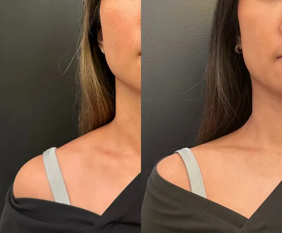 Beautox client result 2