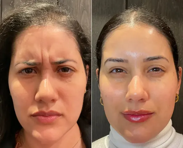 Beautox client result 3