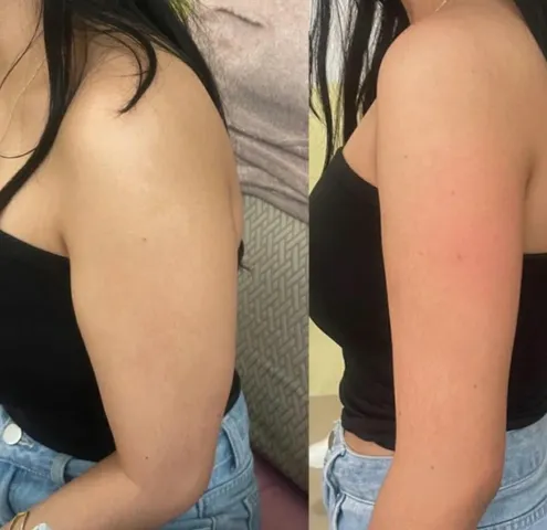 Beautox client result 4
