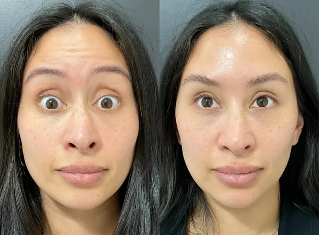 Beautox client result 6
