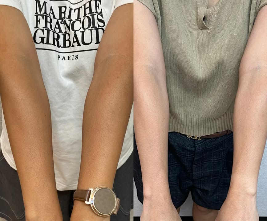 Glutathione Drip & Push client result 1