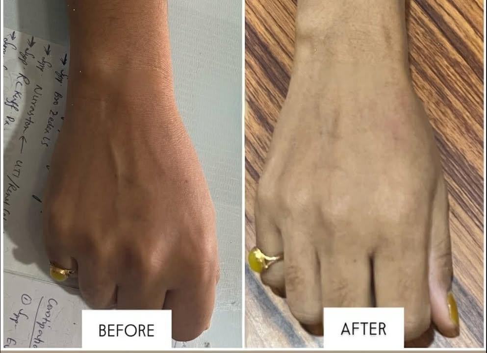 Glutathione Drip & Push client result 2