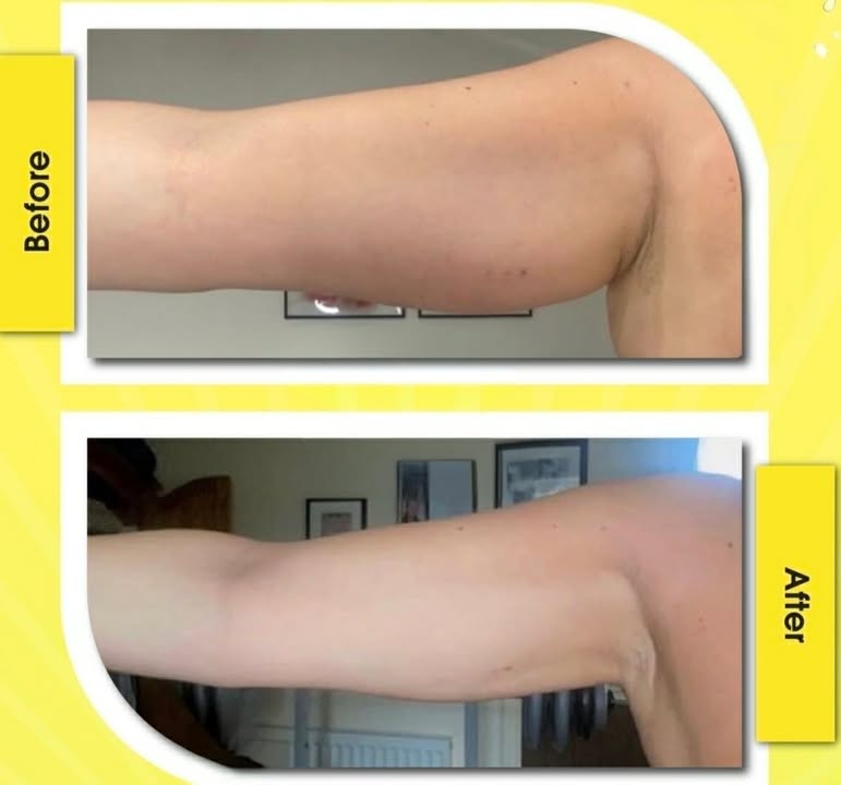 Mesolipo client result 1