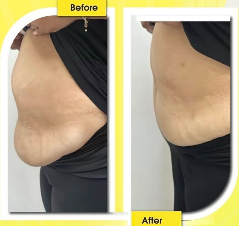 Mesolipo client result 2