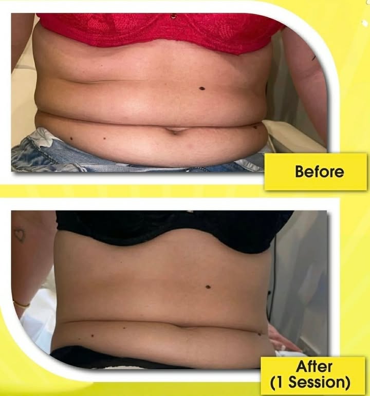 Mesolipo client result 4