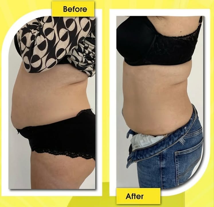 Mesolipo client result 5