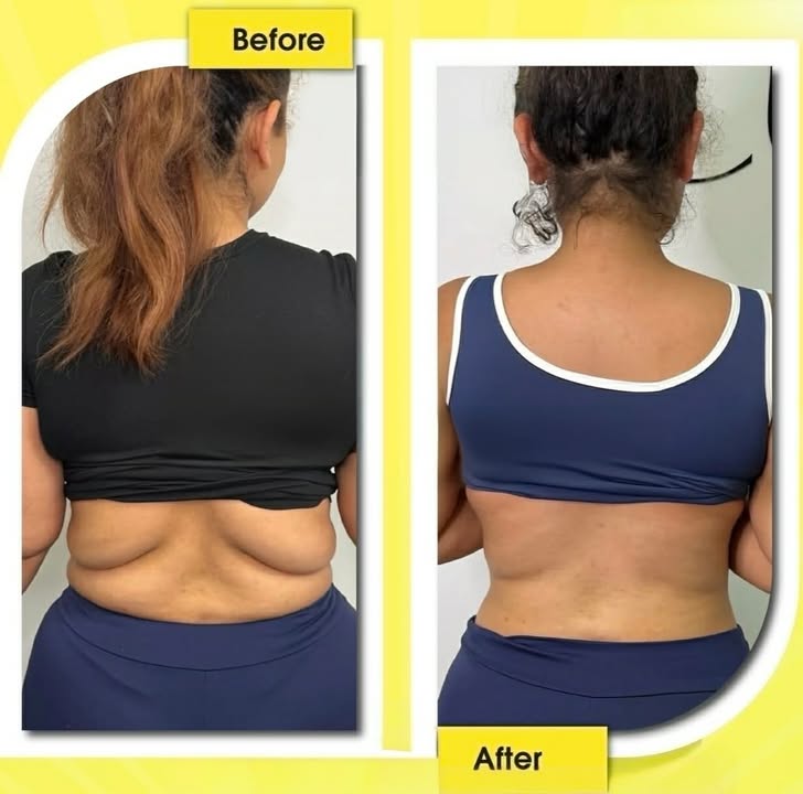 Mesolipo client result 6